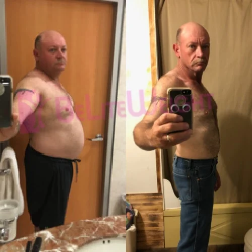 Weight Loss Surgery Before and After Brandon B - 1 Year Update*